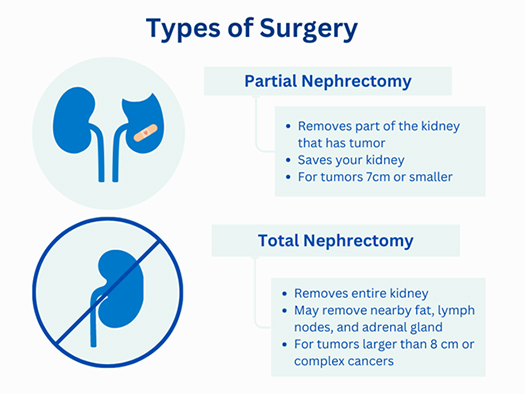Types of Kidney Cancer Surgeries